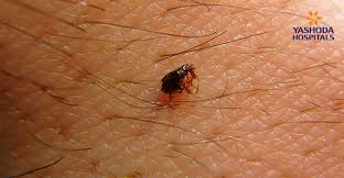 شركةمكافحة البراغيث في مدينة بدر01025025774